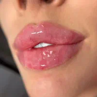 پزشک ژل بوتاکس لیزر اچ پی وی هایفو تتو کربن پلاژن