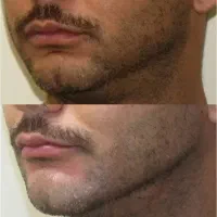 نیازمند مدل برای بوتاکس وژل