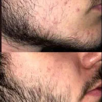 پایان ریش های کم پشت