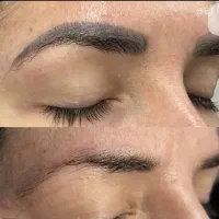 ریمو تتوهای قدیمی(پاک کردن)