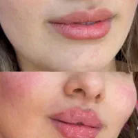 پکیج ویژه لاغری موضعی رویای تناسب اندام بدون جراحی