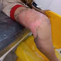 درمان انواع زخم و پانسمان نوین