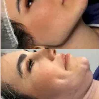 ساکشن غبغب و بوکال فت  ۱۱.۵ میلیون
