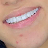 کامپوزیت و زیبایی دندان