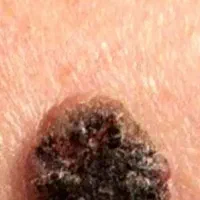 از بین بردن زگیل  وخال گوشتی