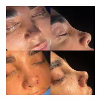 جراحی ها زیبایی با قیمت استثنایی (جراحی بینی۴۱م )