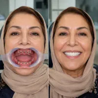 جشنواره ایمپلنت با بهترین قیمت و اقساط