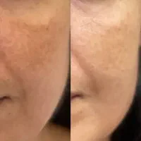 پک ضد لک بیوممتیک