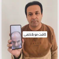 کاشت مو و ابرو به صورت طبیعی   + پرداخت قسطی