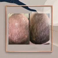 رویش ریش و سبیل و موی سر