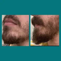 ریشات سکه ای ریخته. یا کوسه ای