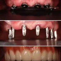 جشنواره دندانپزشکی تخصصی ایمپلنت بااقساط ویژه