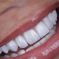 ایمپلنت  ،زیبایی با اقساط و تخفیف ویژه