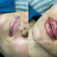 تزریق تخصصی ژل و بوتاکس