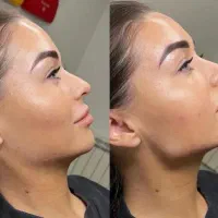 فول فیس صورت،کوچک کردن بینی،بوتاکس ،مزوتراپی