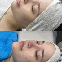 ریمو تاتو و لیزر مو زائد