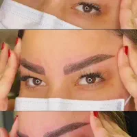 تتو لیزر ریمو چالگونه دائم میکرو کراتین
