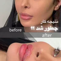 تزریق ژل و بوتاکس بهاره
