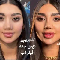 ژل تزریق بوتاکس هایفو  مزو۶۹۹