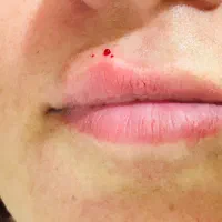آموزش فیلرو بوتاکس و مزو....
