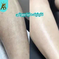لیزر مو زائد(مایابیوتی)تضمینی با ضمانت برگشت پول