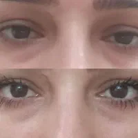 فشیال پوست با محصولات گیاهی