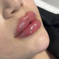 تزریق ژل لب (مدل گیری محدود)بامتریال اورجینال