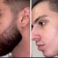 ریشاتون تضمینی در میاد
