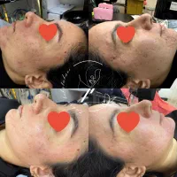 درمان تخصصی جای جوش صورت