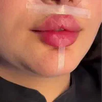 تخفیف بوتاکس،فیلربادی،بیکینی،باسن/هیپ دیپ