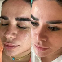 فیشیال پاکسازی و درمان تضمینی پوست|خدمات آرایشگری و زیبایی|کرمانشاه, |دیوار