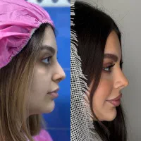 بینی جشنواره زیبایی عمل بینی