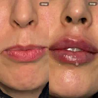 بوتاکس ژل فیلر