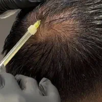 پی ار پی و مزو سرویس صورت  ۱۰۰درصد تضمینی