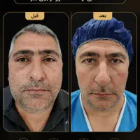 لیفت شقیقه . جراحی پلک بلفاروپلاستی|خدمات زیبایی و سلامت|ساری, |دیوار