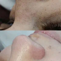 فشیال و پاکسازی پوست
