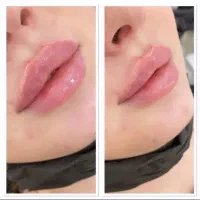 اموزش ژل بوتاکس مزو ژل درمان لک درمان میگرن