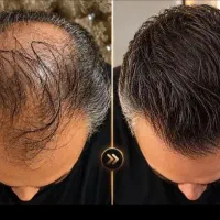 پرپشت کننده ریش ومو