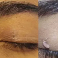 برداشتن خال رفع پف پلک و کوچک کردن بینی بدون جراحی