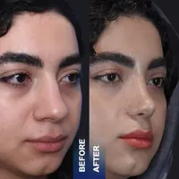جراحی بینی ابدو‌ساکشن بلفارو(پلک) تیپ پلاستی کاشت|خدمات آرایشگری و زیبایی|مشهد, سجاد شهر|دیوار
