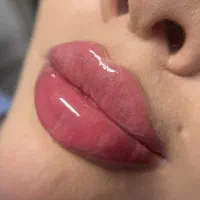 ژل و بوتاکس فردیس