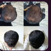 اگر از ریزش مو خسته شدی این آگهی مخصوص توئه