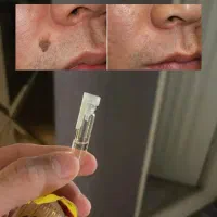 خشک کن زاییده های رو.ی ب.دن رو