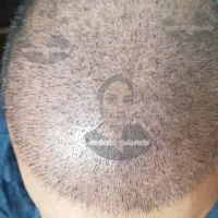 جشنواره تابستانه کاشت مو پرتراکم