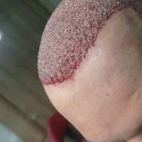 کاشت مو طبیعی