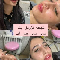 لیزر مطب ساکشن لب زیرچشم بلفارو گونه