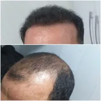 کاشت موی طبیعی سبک شیرازی|خدمات آرایشگری و زیبایی|تهران, زعفرانیه|دیوار