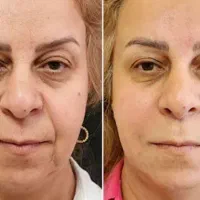 کرم های بیوممتیک