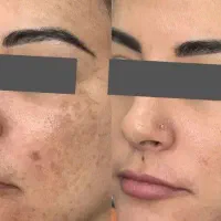 بیوممتیک ضدلک تضمینی/ویتامین c