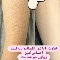 تخفیفات 30 درصدی لیزر کندلا ۲۰۲۶ دکتر ویسی